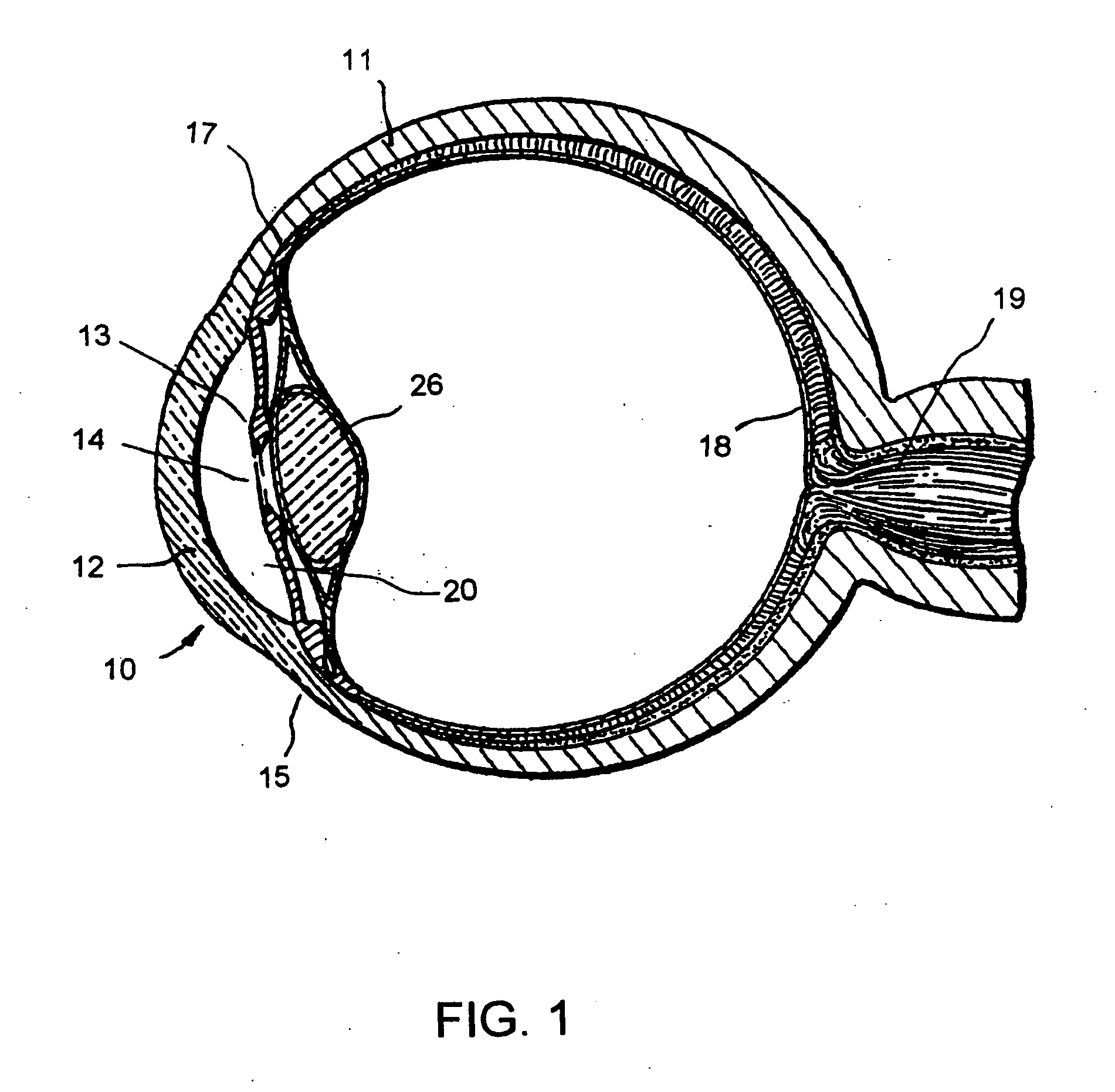 Ophthalmology implants and methods of manufacture