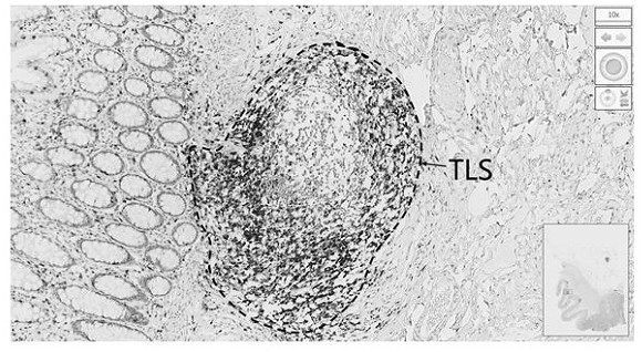 Marker and model construction method and system for prognosis prediction of colon cancer