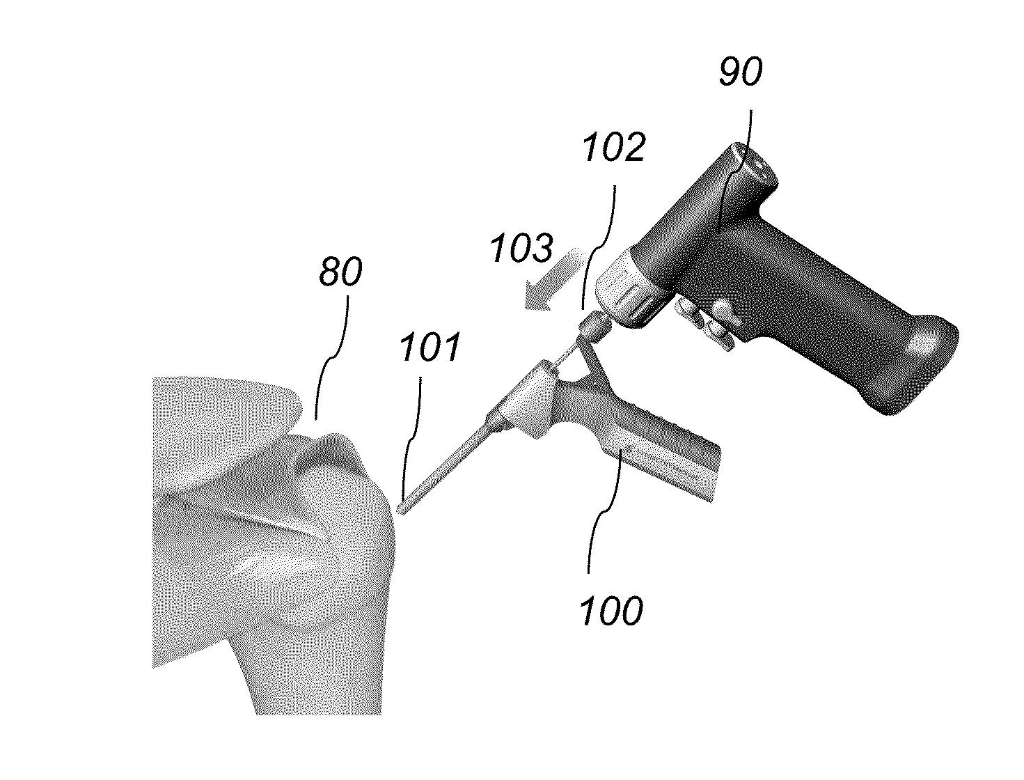System and method for forming a curved tunnel in bone