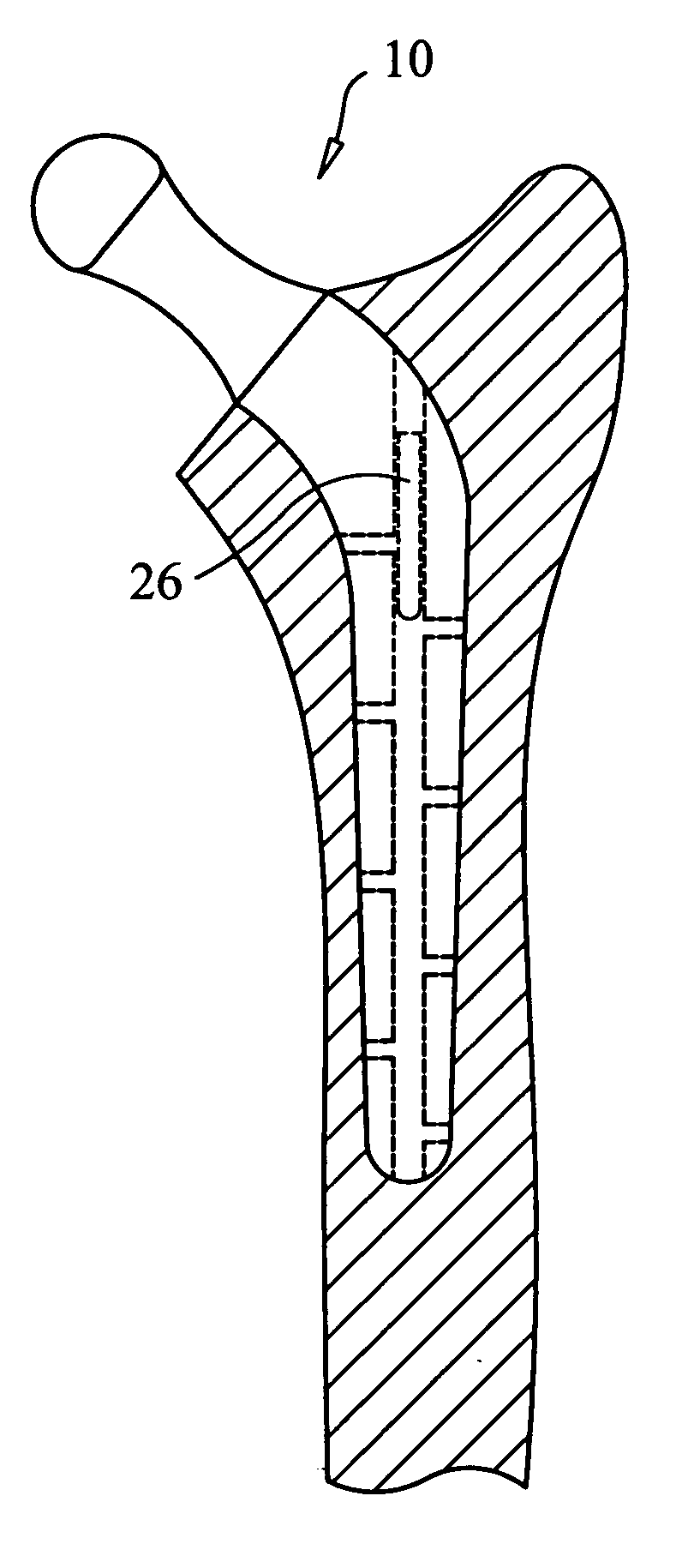 Orthopedic system for total hip replacement surgery