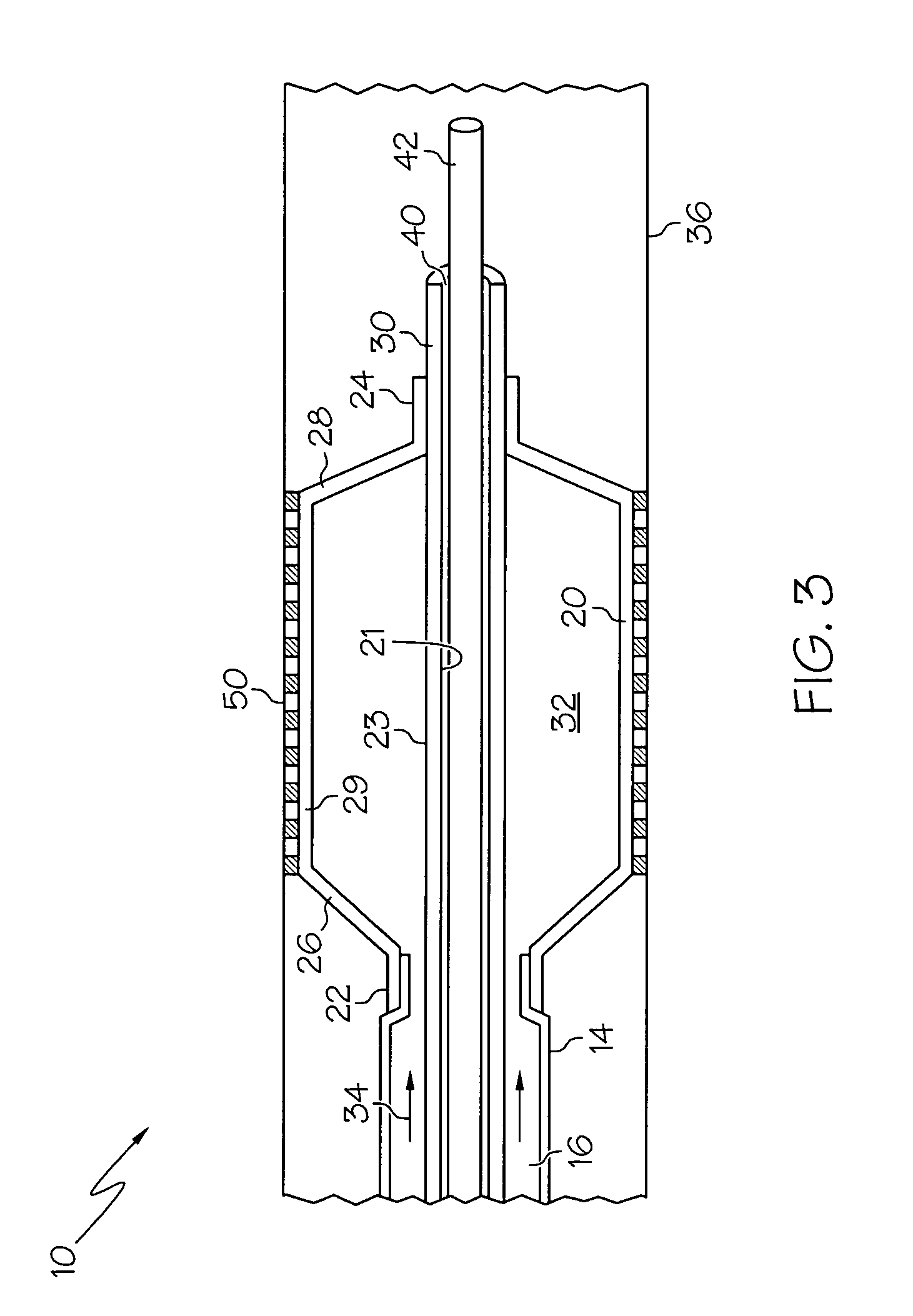 Balloon catheter with expandable wire lumen