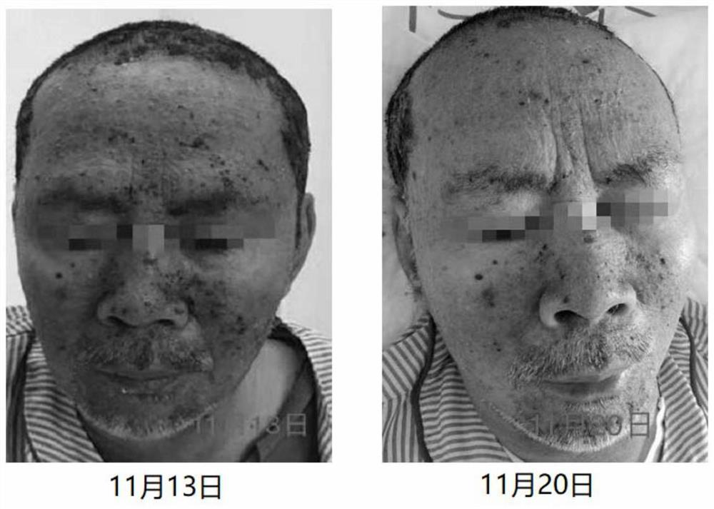 A traditional Chinese medicine facial mask for treating skin rash associated with tumor molecular targeting drugs and its preparation method