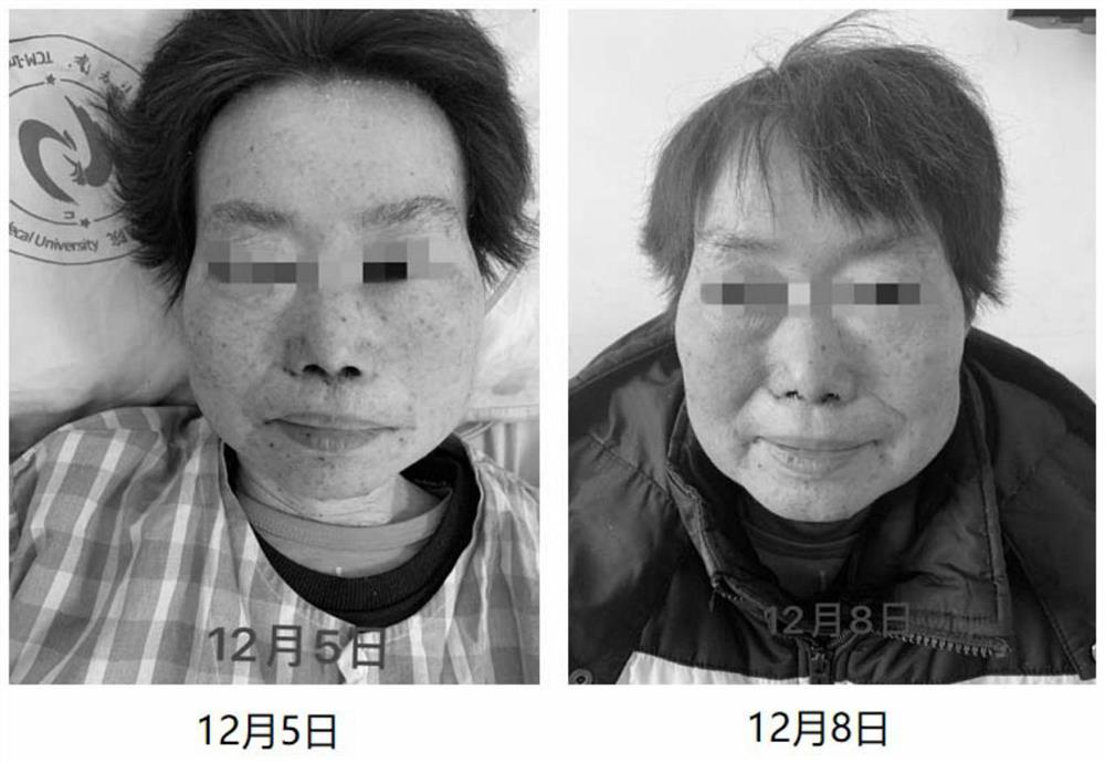 A traditional Chinese medicine facial mask for treating skin rash associated with tumor molecular targeting drugs and its preparation method