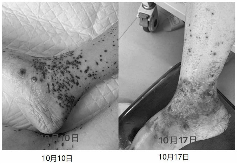 A traditional Chinese medicine facial mask for treating skin rash associated with tumor molecular targeting drugs and its preparation method