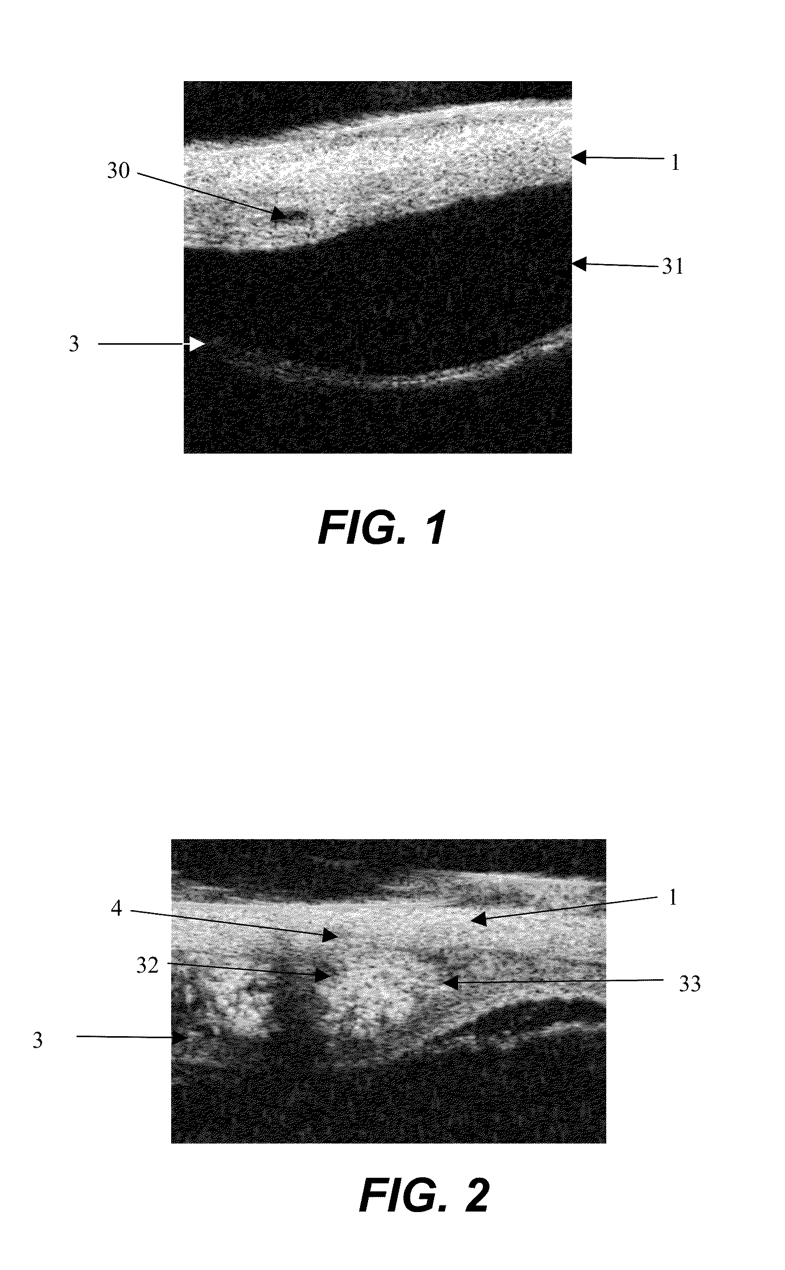 Apparatus and formulations for suprachoridal drug delivery
