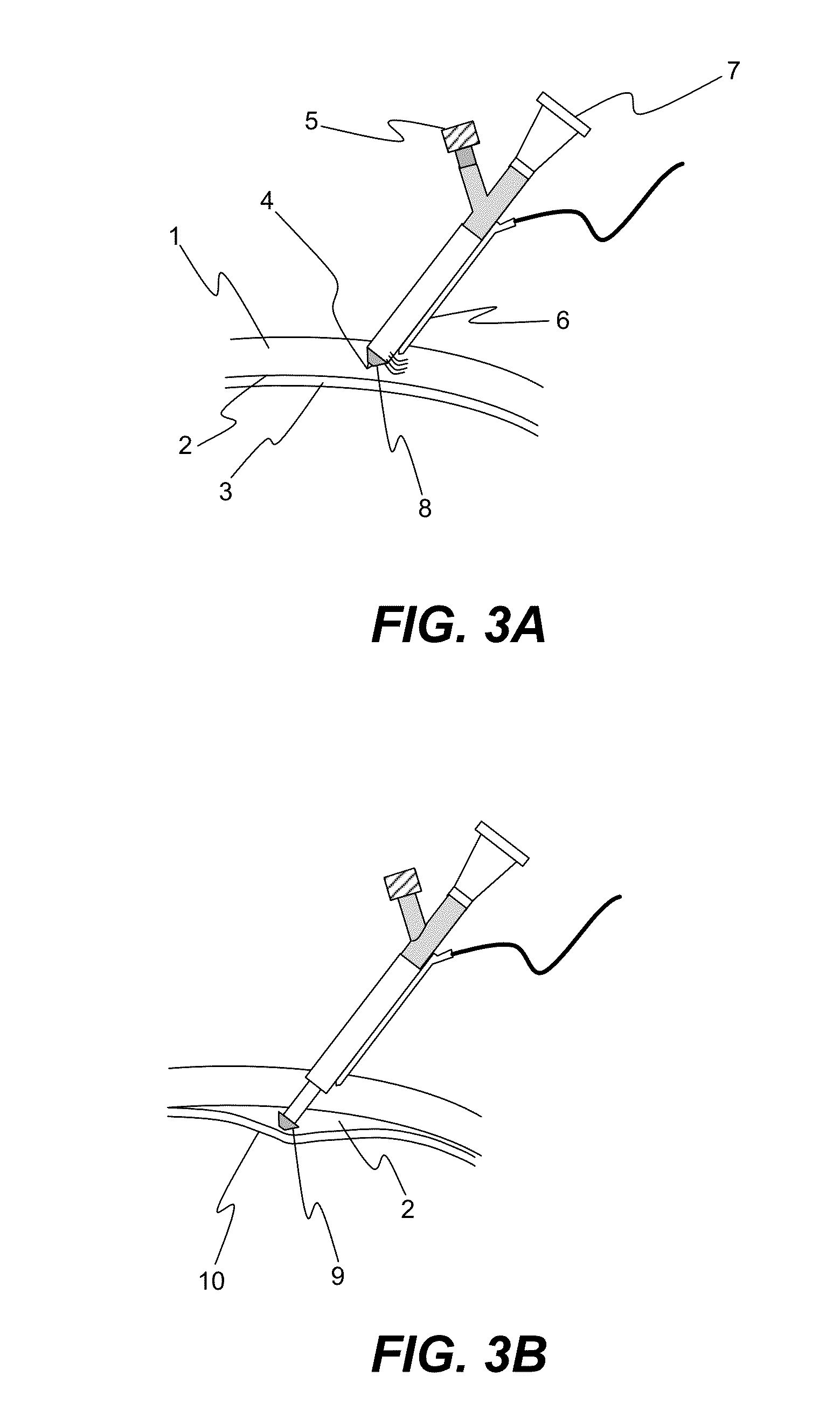Apparatus and formulations for suprachoridal drug delivery