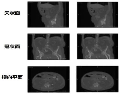 Kidney benign and malignant tumor classification method based on multi-view information cooperation