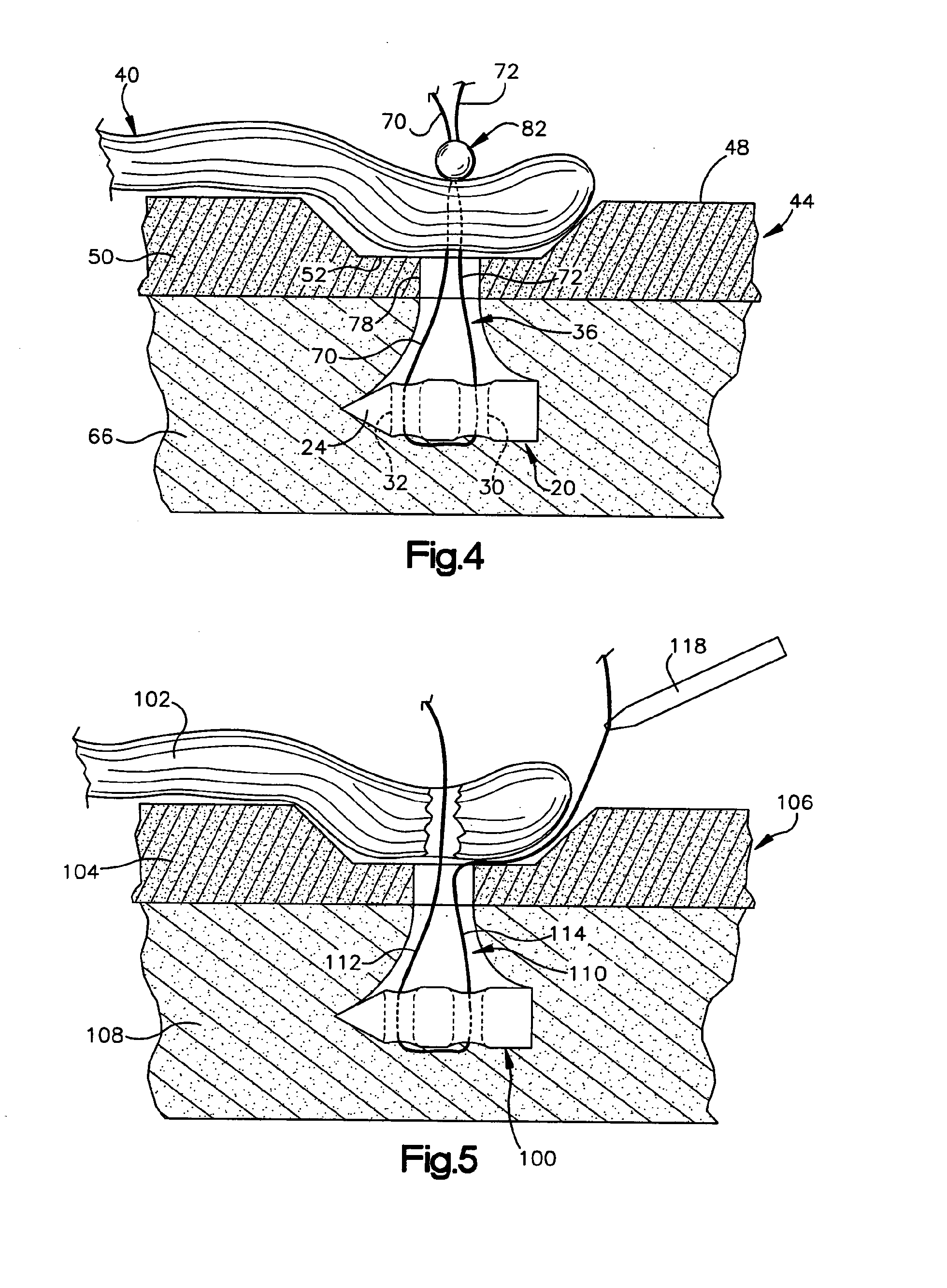 Method of connecting body tissue to a bone