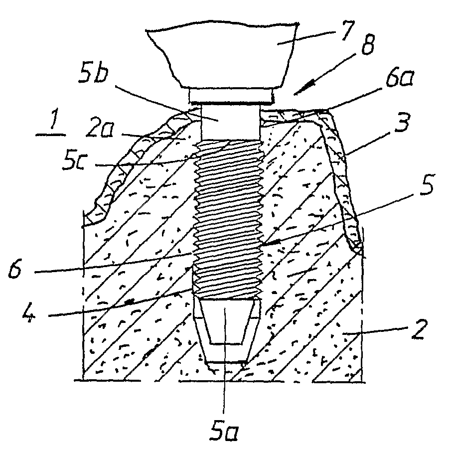 Implant For Dental Prosthesis, And Method And System For Producing The Implant