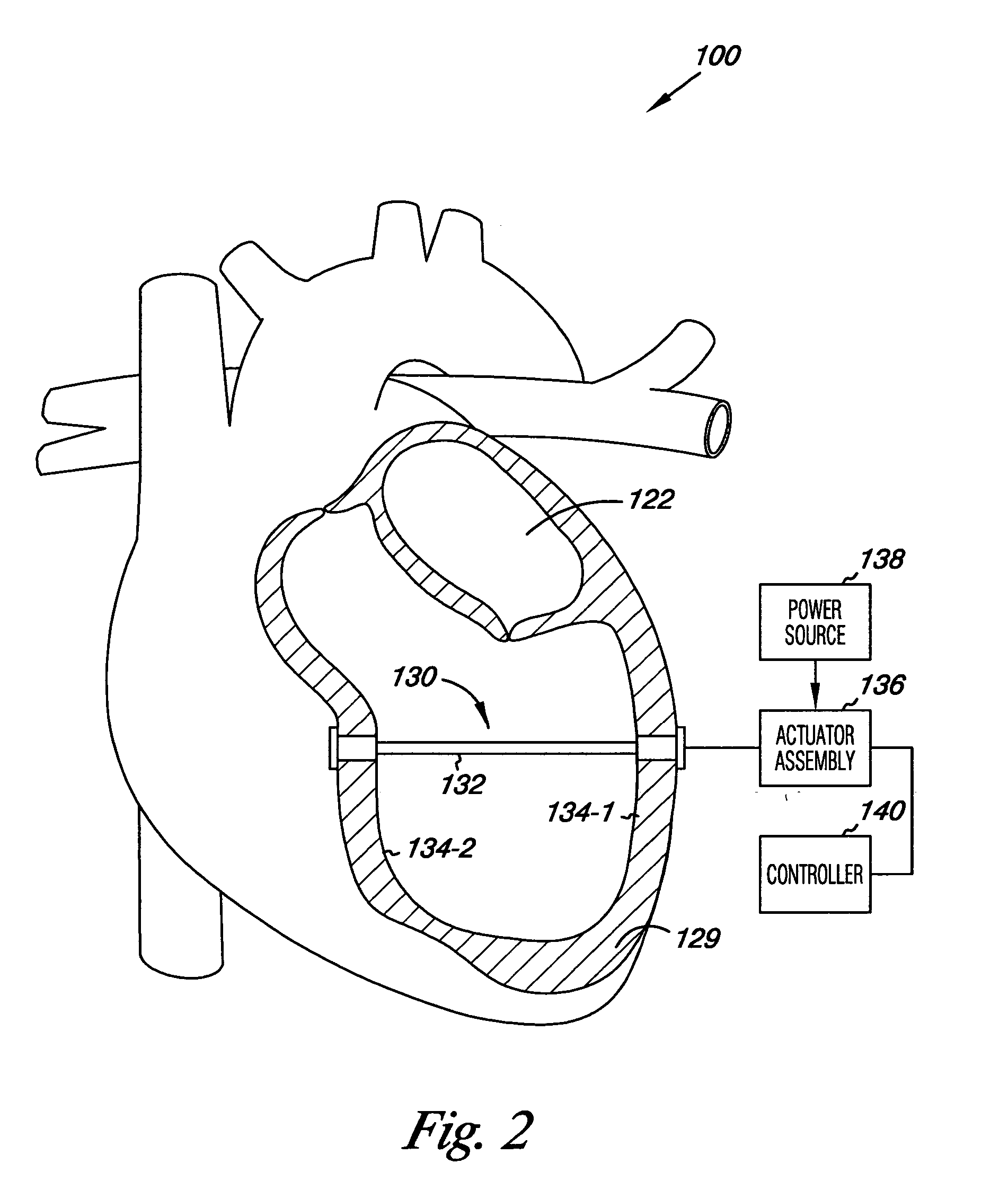 Ventricular assist and support device