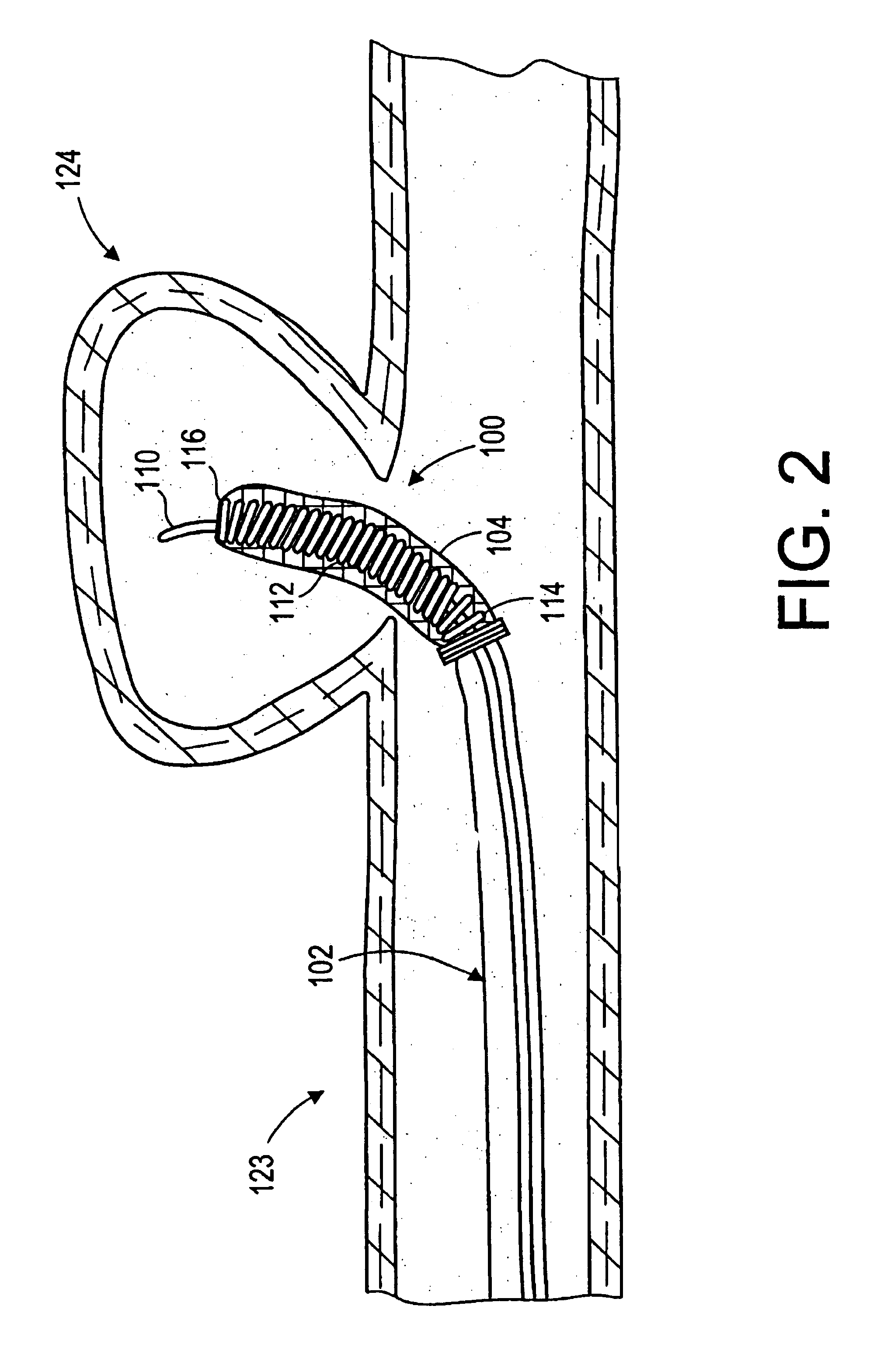 Aneurysm liner with multi-segment extender