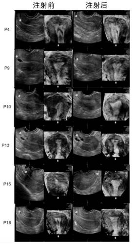 Targeted growth factor for promoting scar endometrium reconstruction of infertile women and application of targeted growth factor