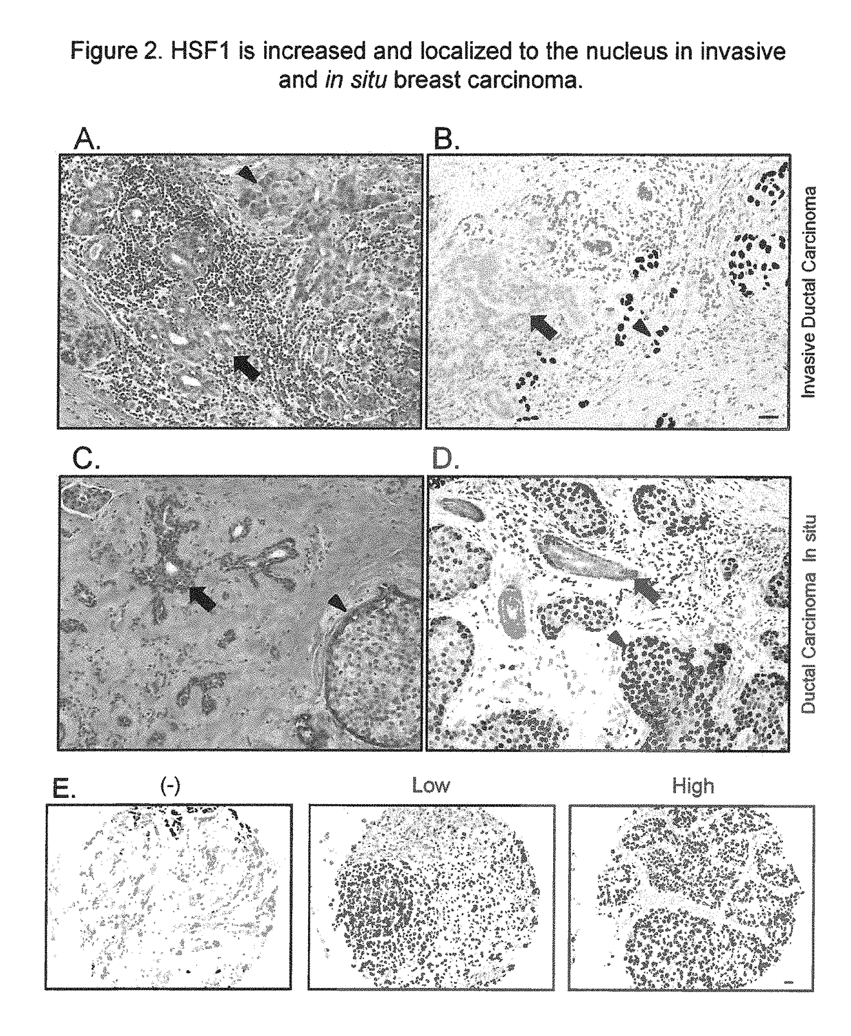 HSF1 as a marker in tumor prognosis and treatment