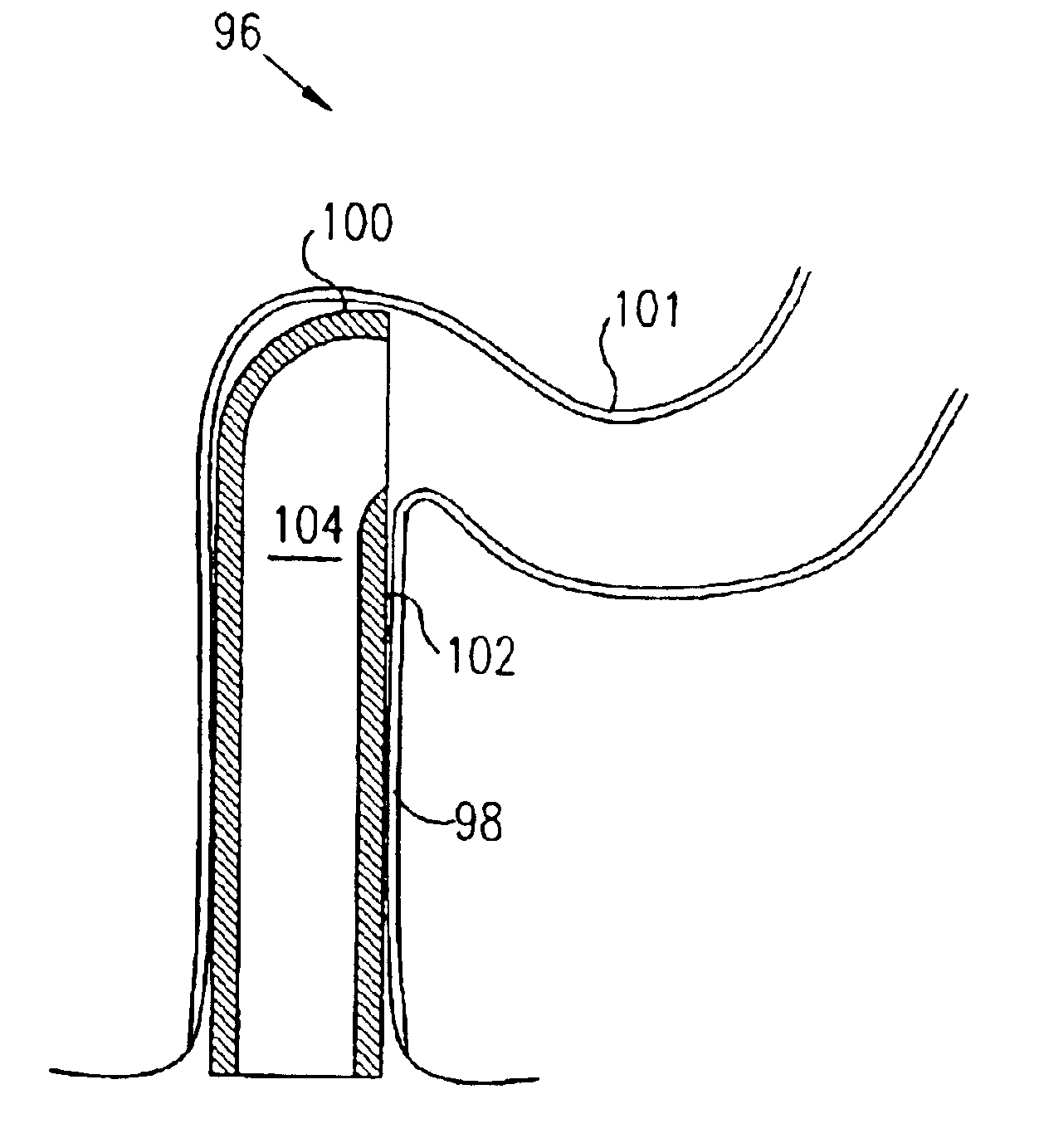 Method for insertion of an endoscope into the colon