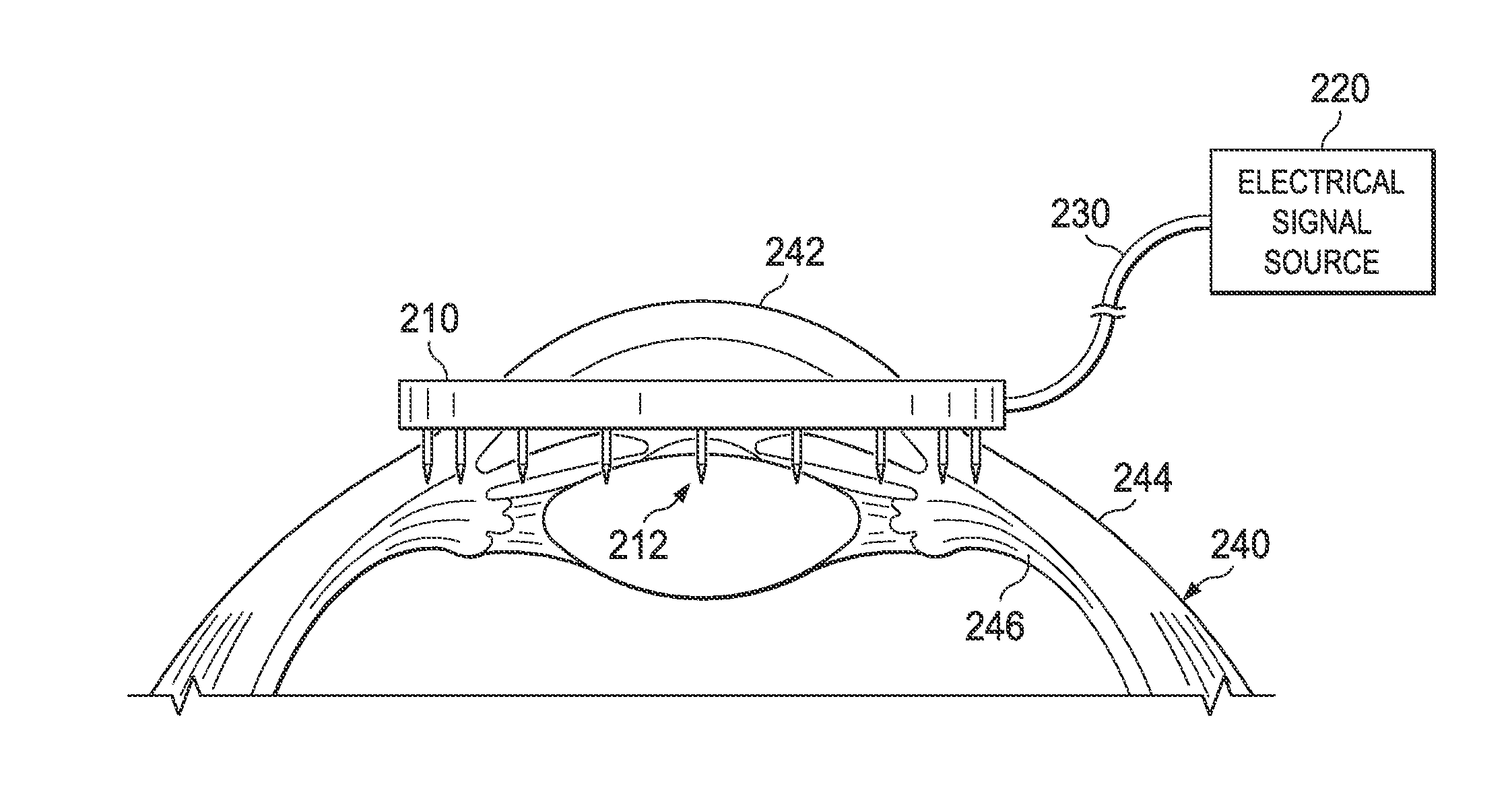System and procedure for enhancing ocular drainage