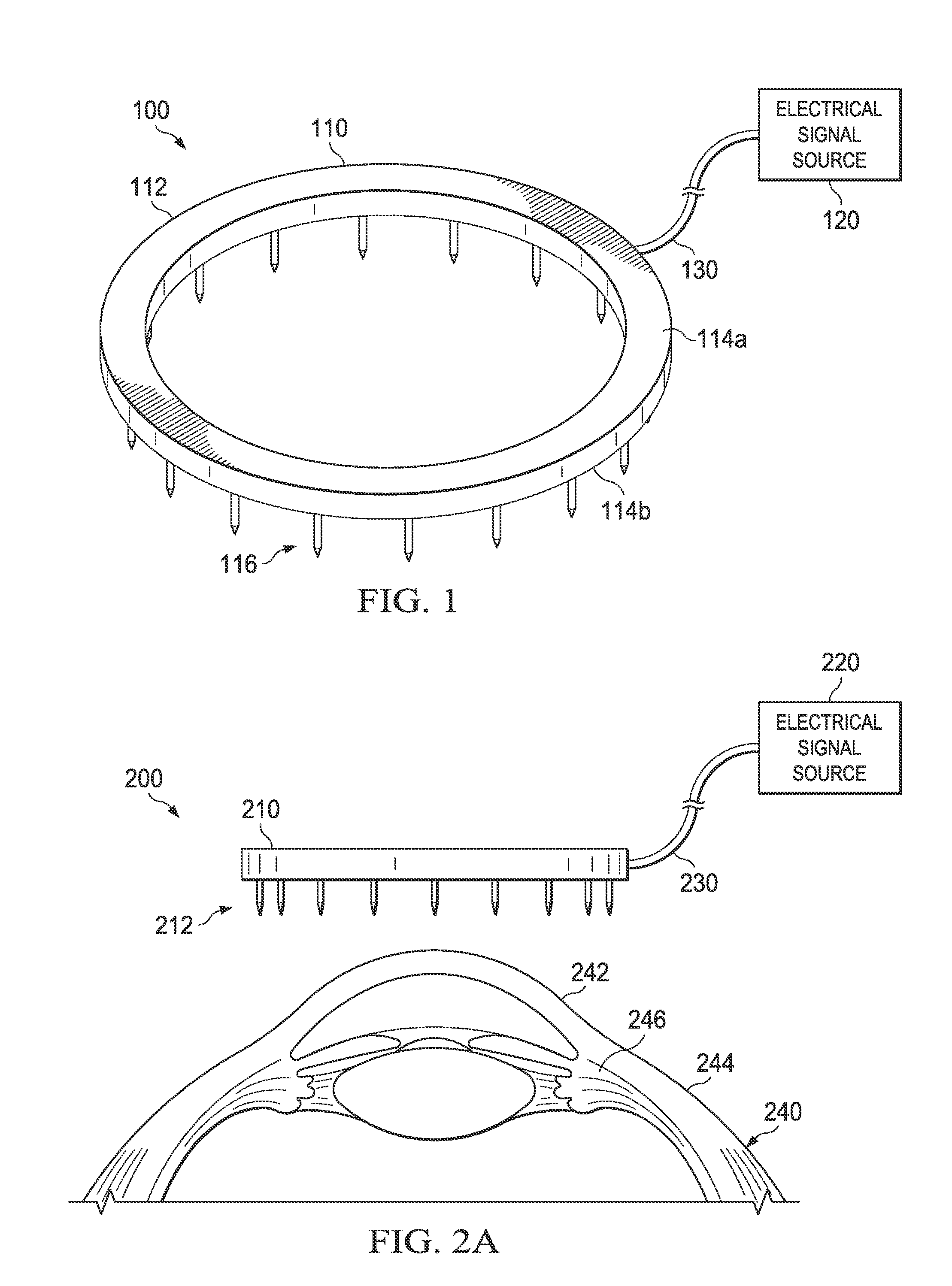 System and procedure for enhancing ocular drainage