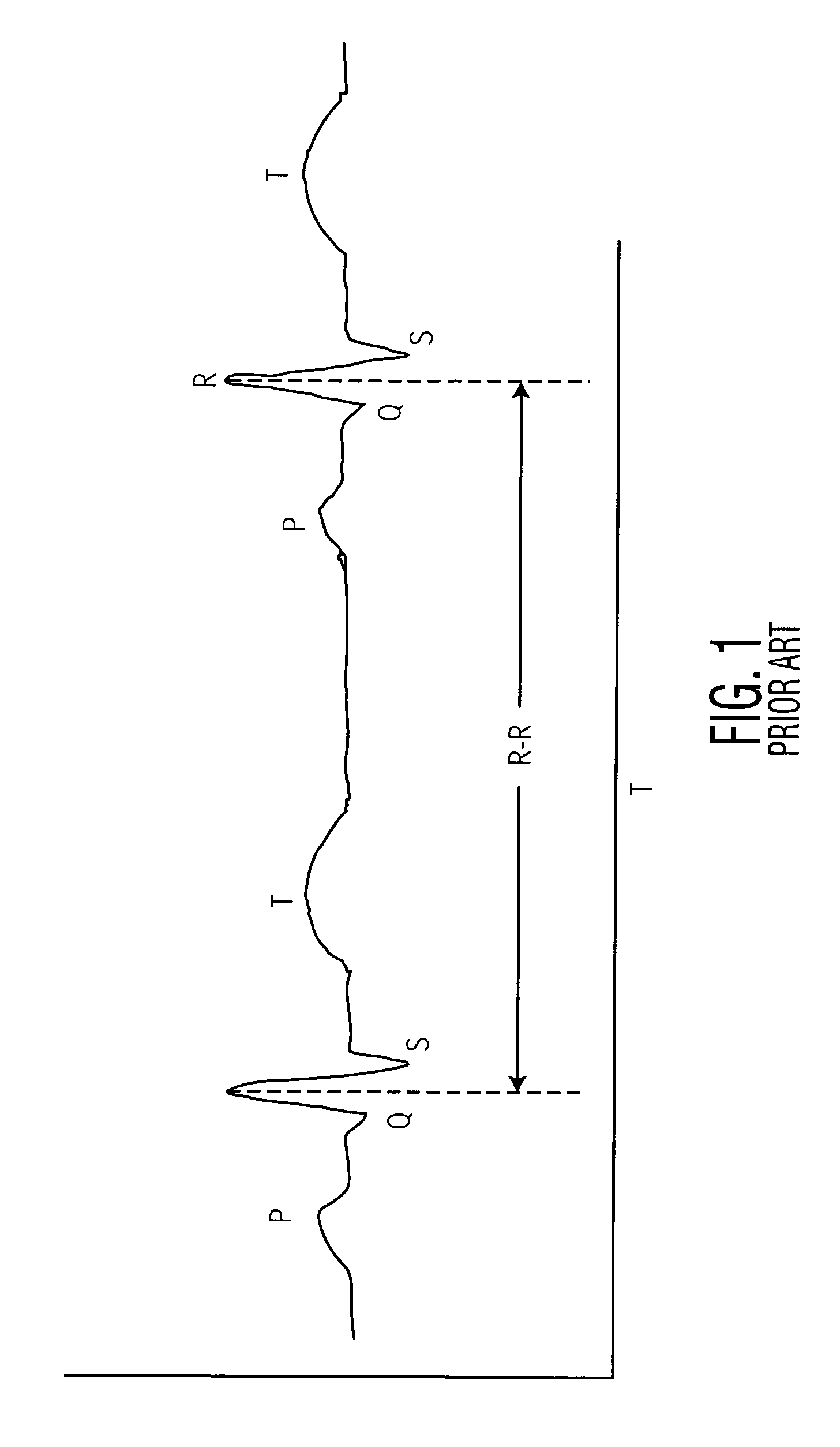 External atrial defibrillator and method for personal termination of atrial fibrillation