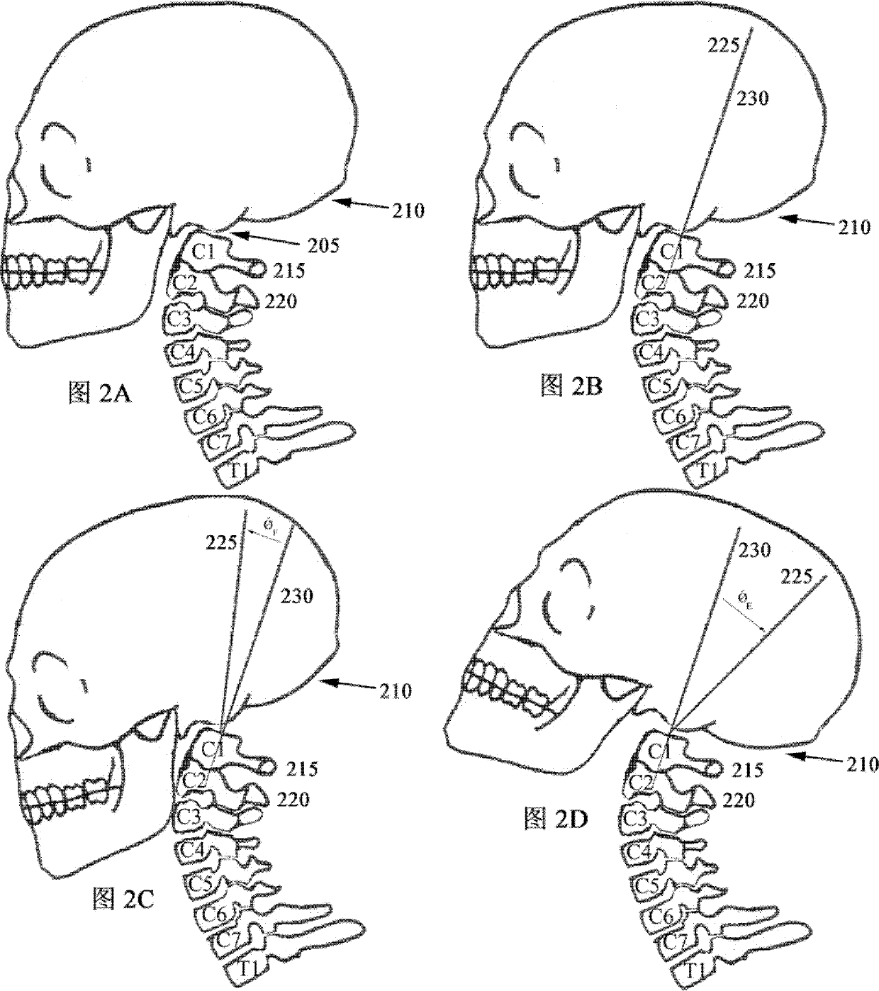 Patient interface equipment and method for aligning adjacent cervical vertebras by aid of same
