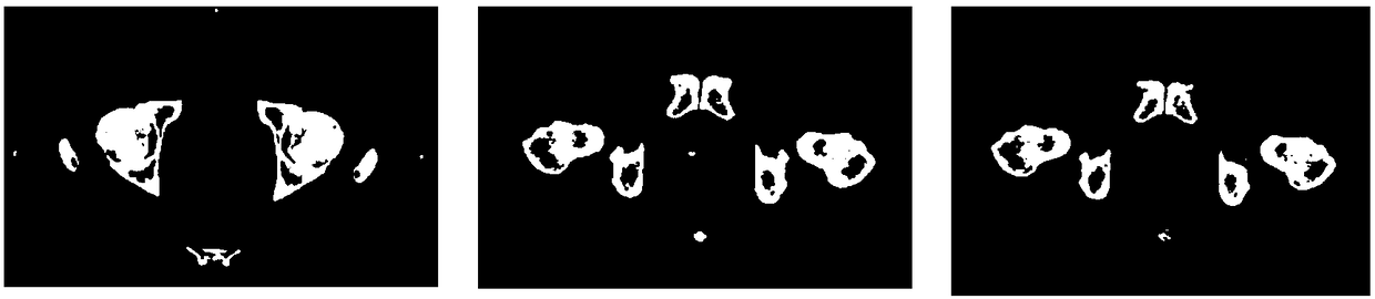 Prostate 3D Image Segmentation Method Based on Gigabit Electron Computed Tomography