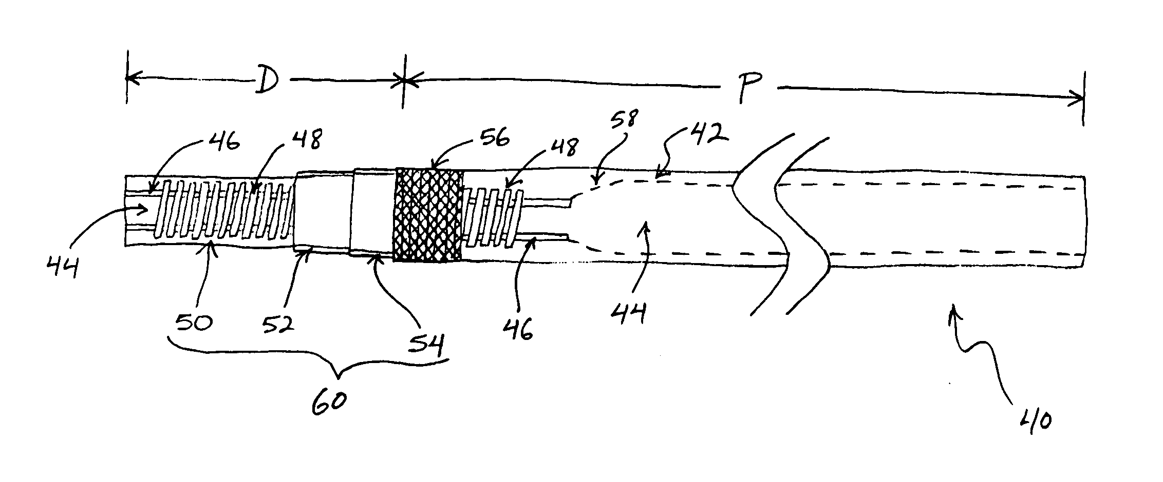 Catheter for intrafallopian contraceptive delivery