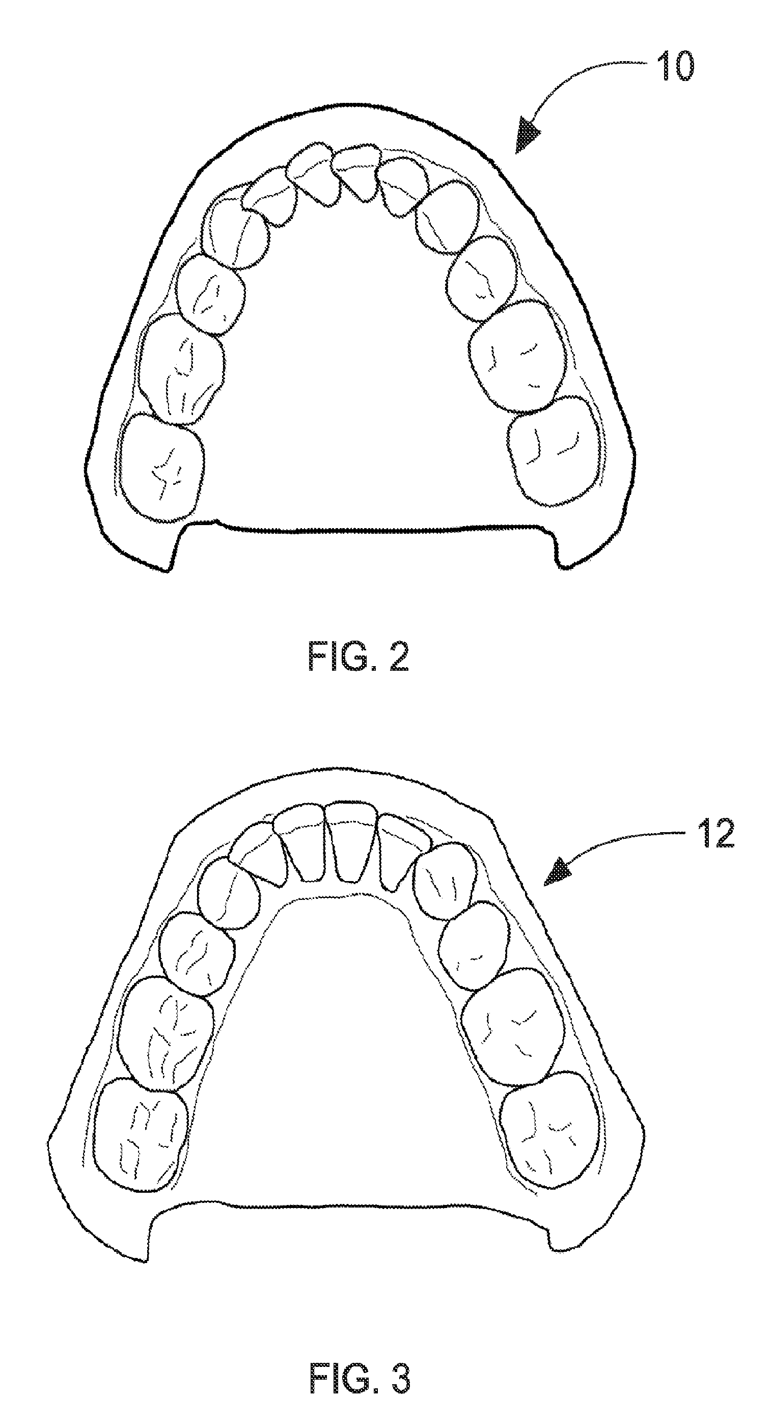 Orthodontic aligner fabrication by overlay method