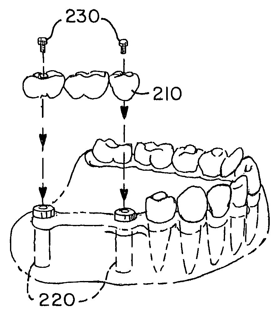 Stable dental analog