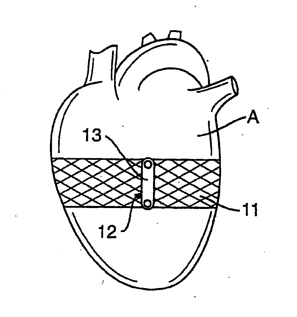 Heart Wall Tension Reduction Apparatus and Method