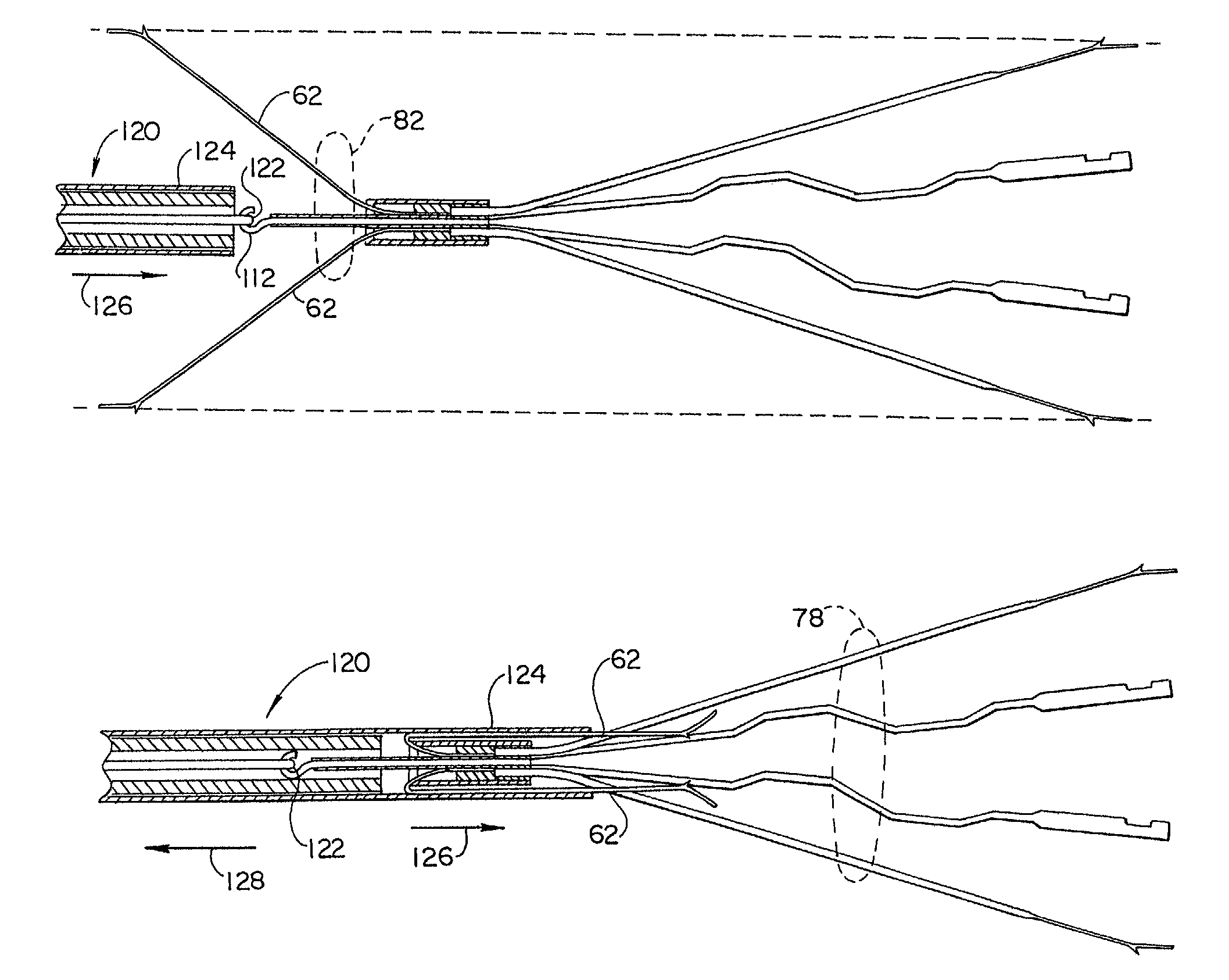 Atraumatic anchoring and disengagement mechanism for permanent implant device