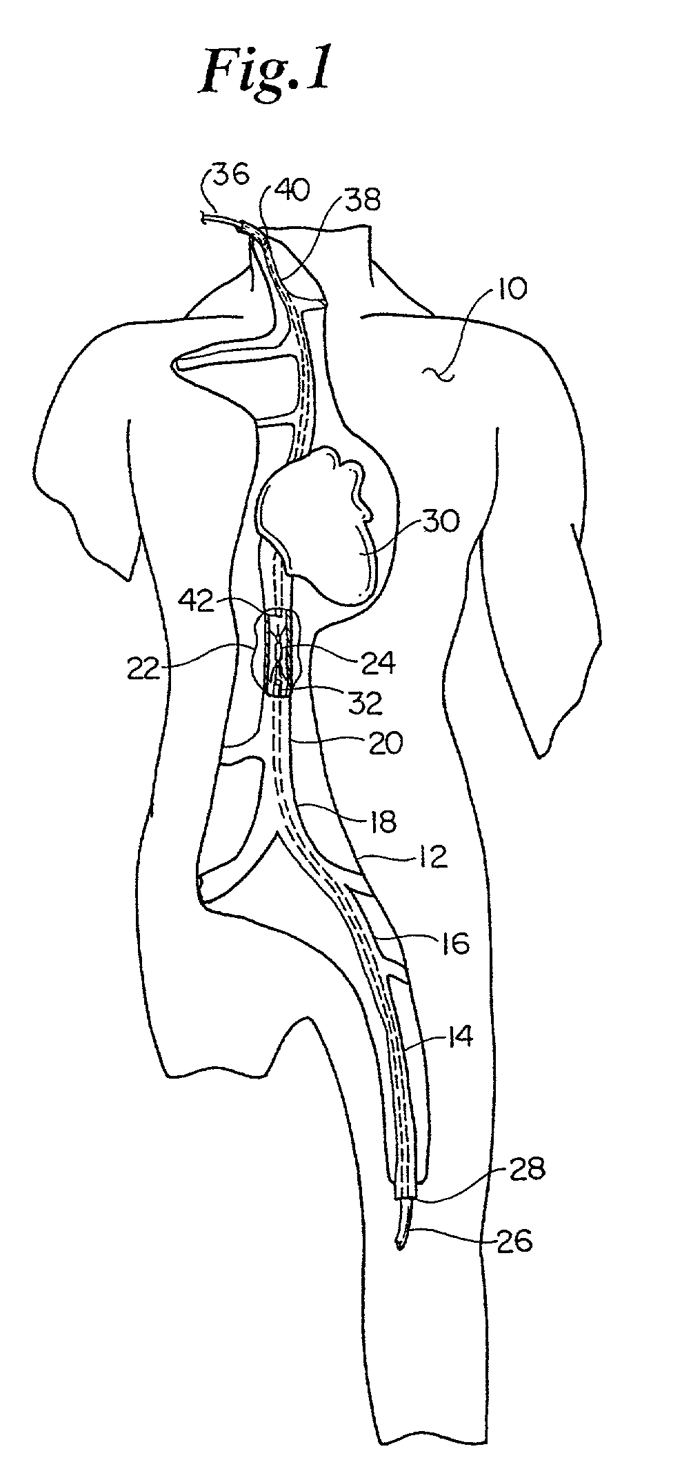 Atraumatic anchoring and disengagement mechanism for permanent implant device