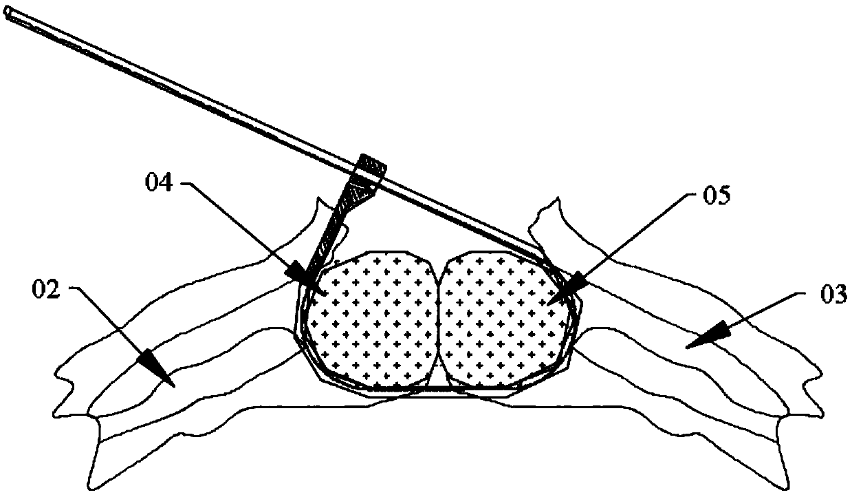 Medical orthopedic implantation bundling strap