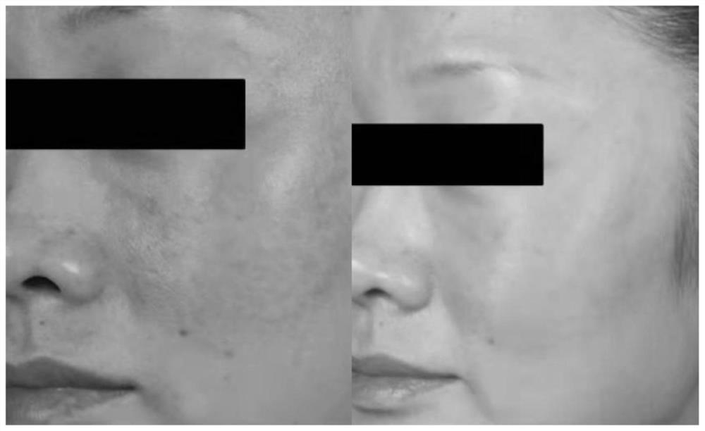 Composite solution with combined application of recombinant III-type humanized collagen and hyaluronic acid and preparation process of composite solution