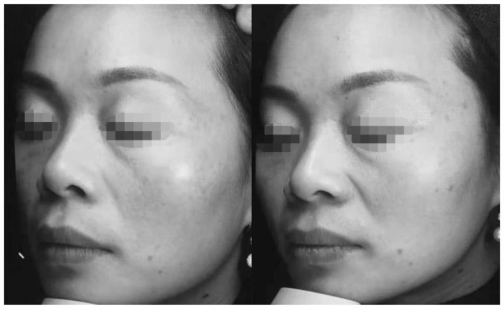 Composite solution with combined application of recombinant III-type humanized collagen and hyaluronic acid and preparation process of composite solution