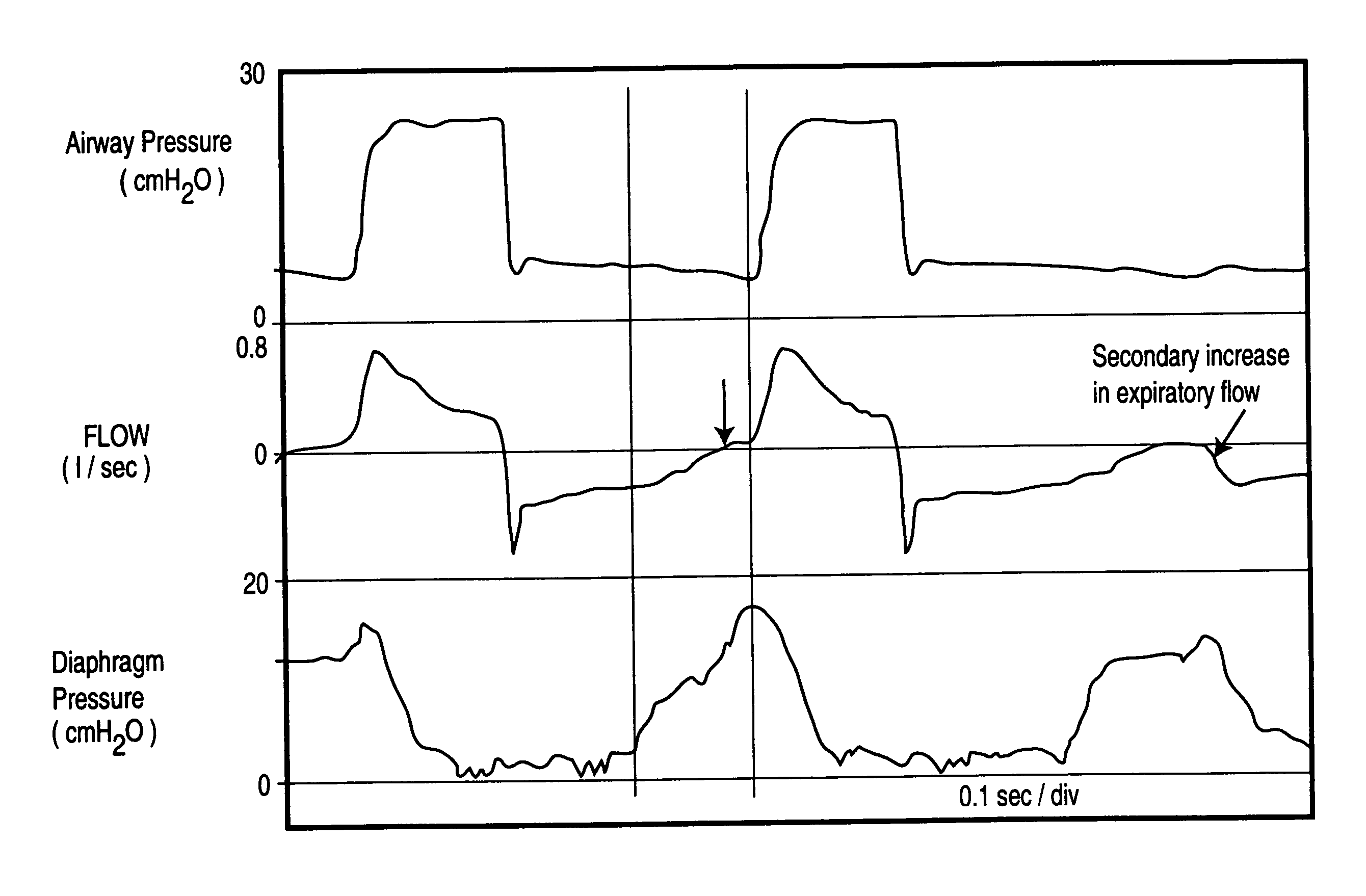 Method and device for monitoring and improving patient-ventilator interaction