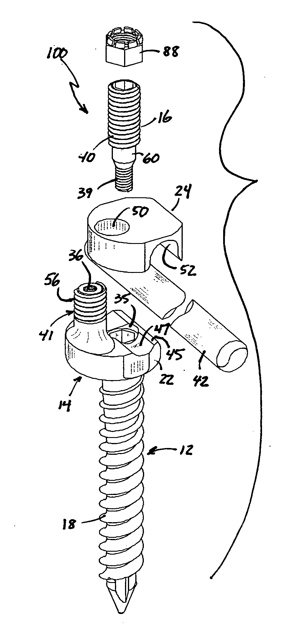 Rod and plate system for incremental reduction of the spine