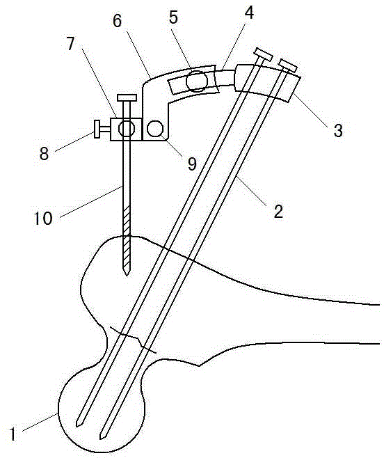 Femoral neck fracture fixing and positioning device