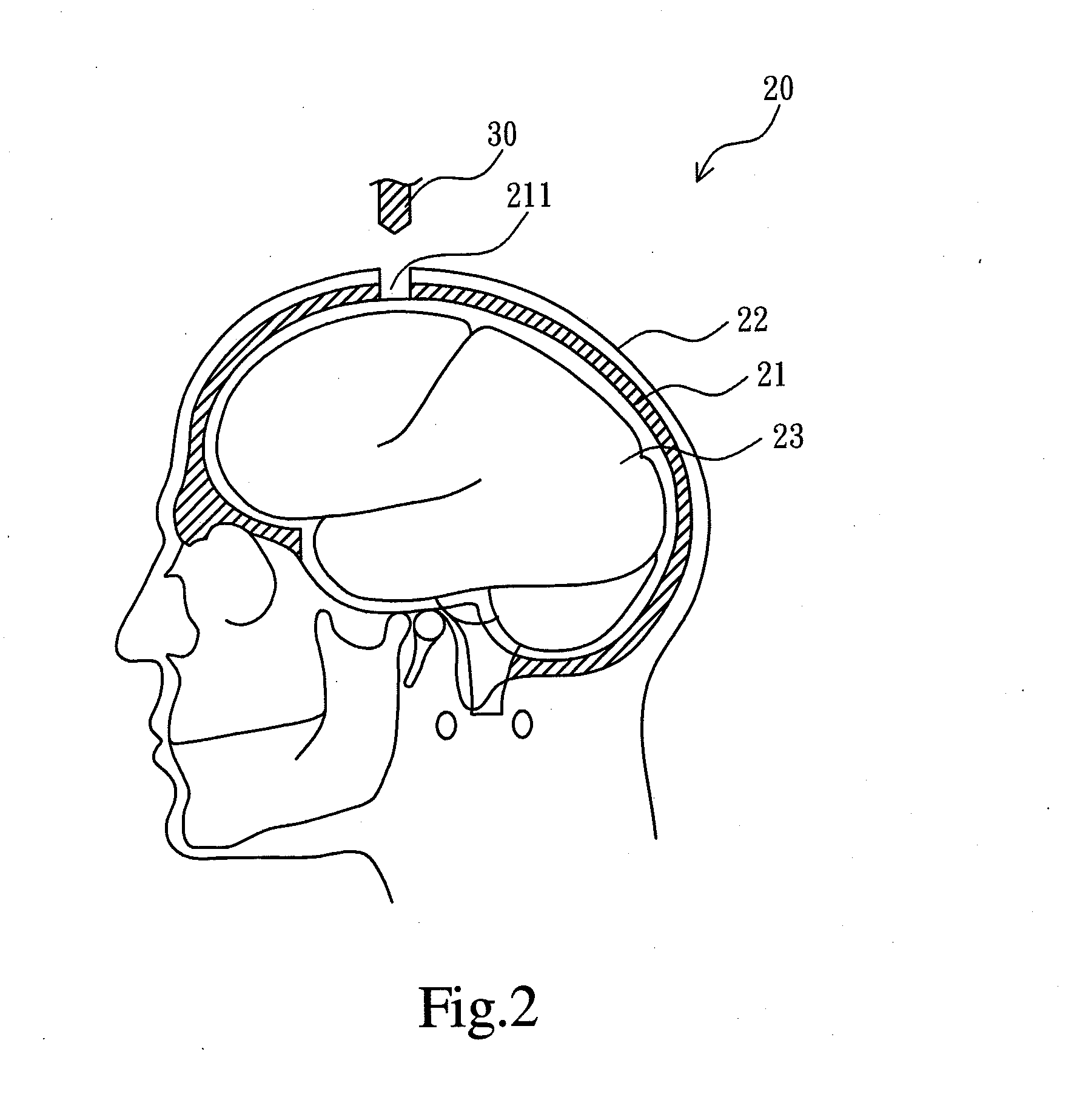 Skull endosseous module for ultrasound penetration
