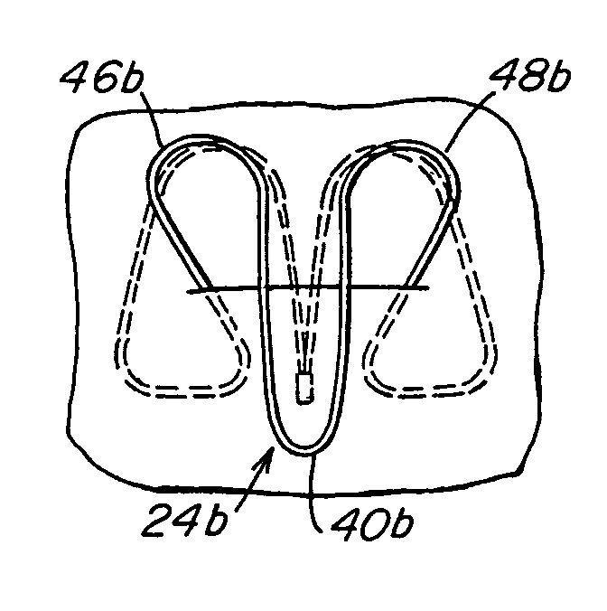 Patent foramen ovale (PFO) closure clips