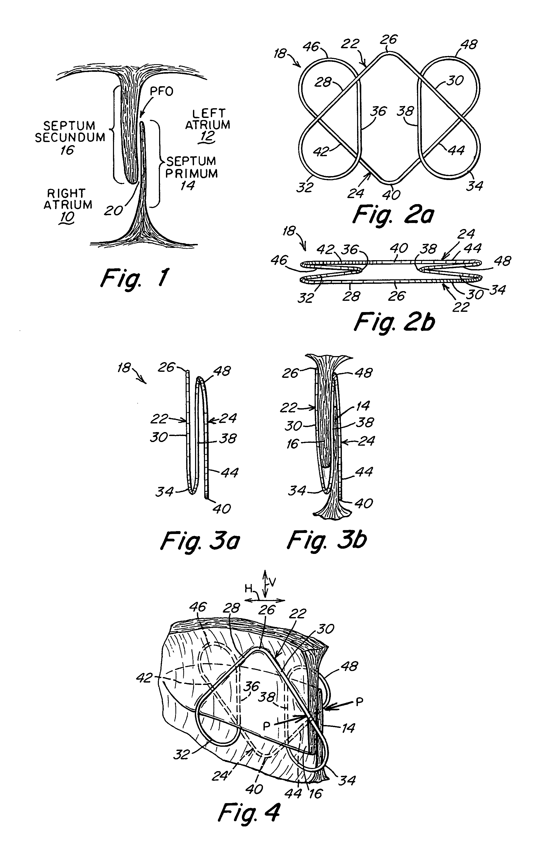 Patent foramen ovale (PFO) closure clips
