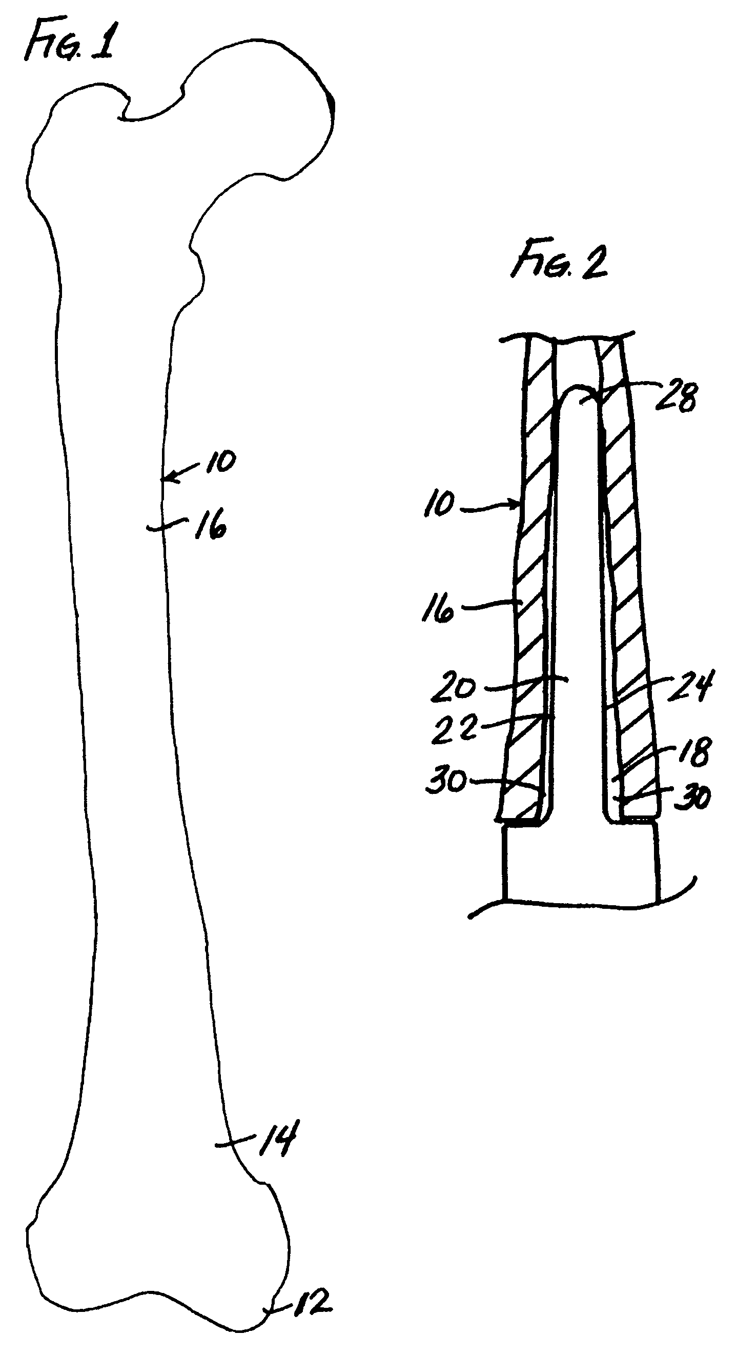 Modular implant system and method with diaphyseal implant