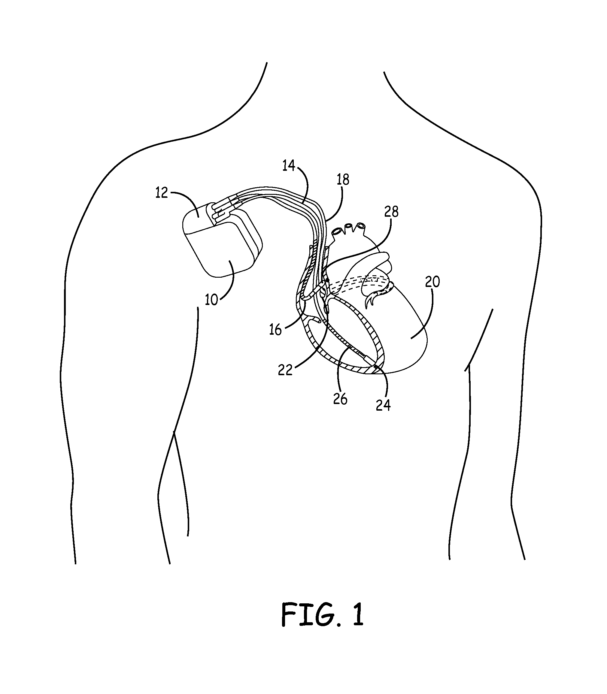 System and method of determining cardiac pressure