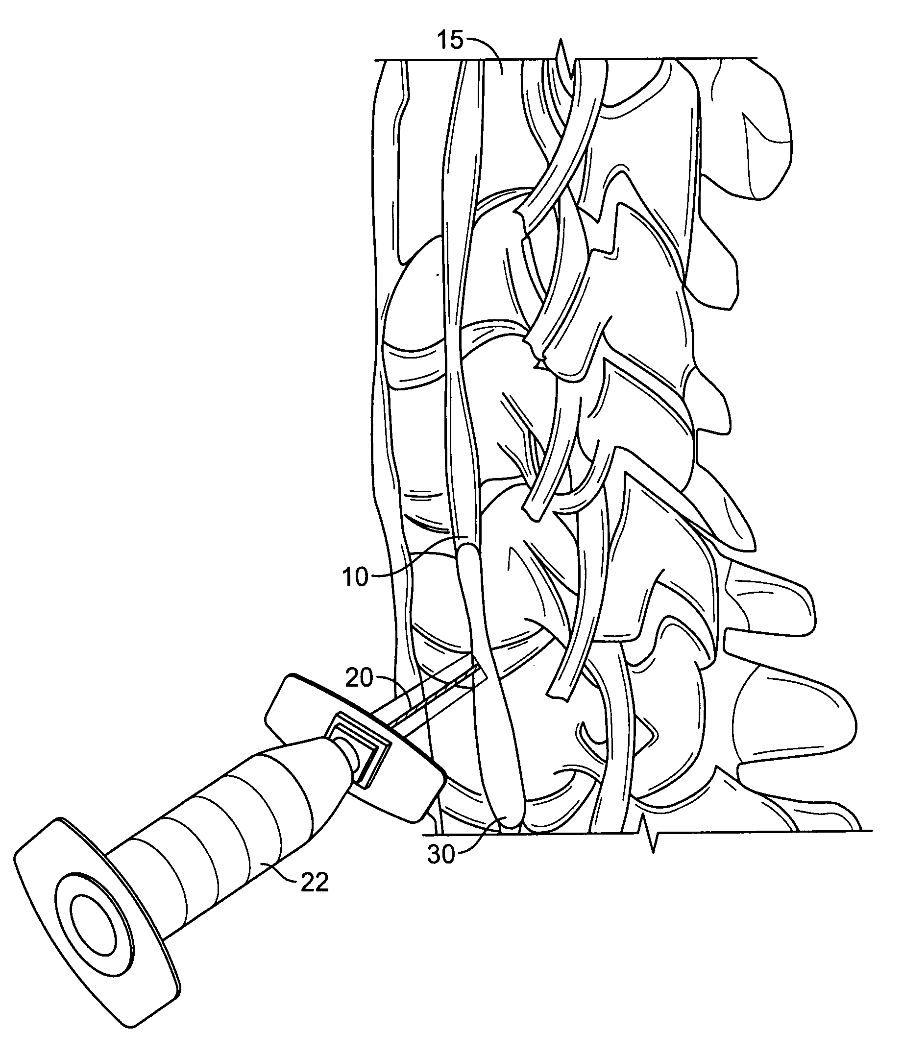 Use of stellate ganglion block for the treatment of erectile dysfunction