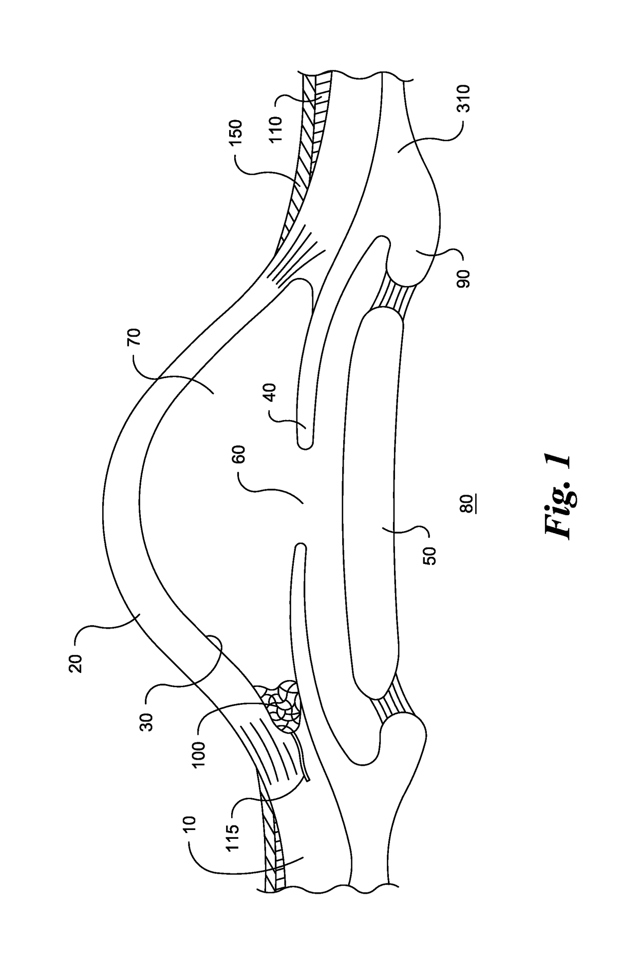 Eye implant devices and method and device for implanting such devices for treatment of glaucoma