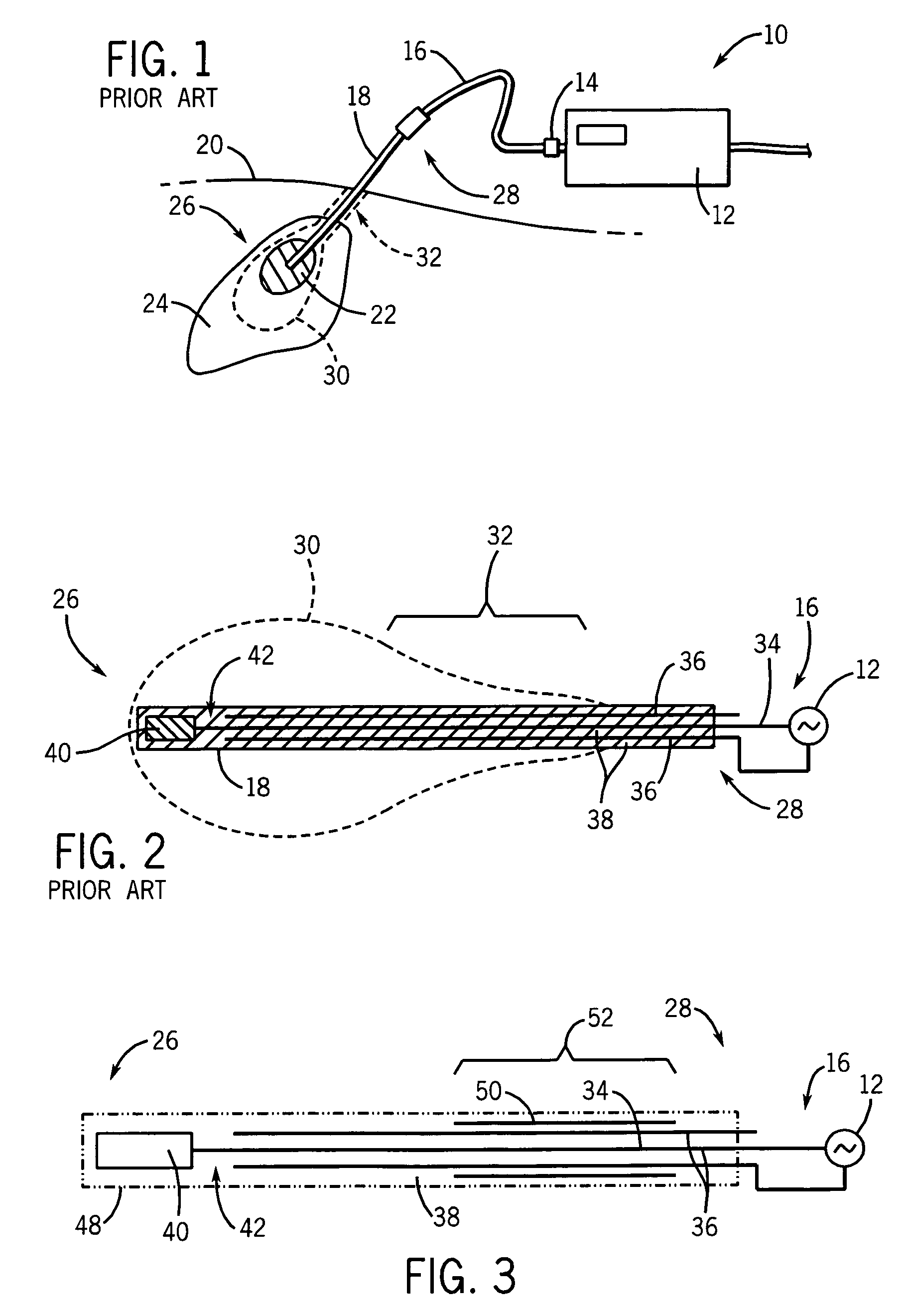 Floating sleeve microwave antenna for tumor ablation
