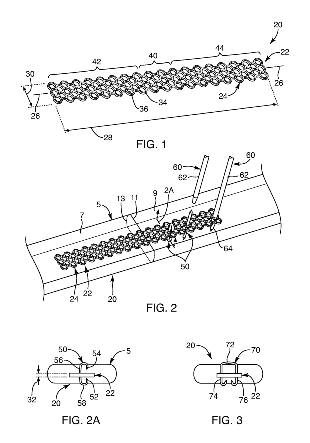 Soft tissue repair devices, systems, and methods