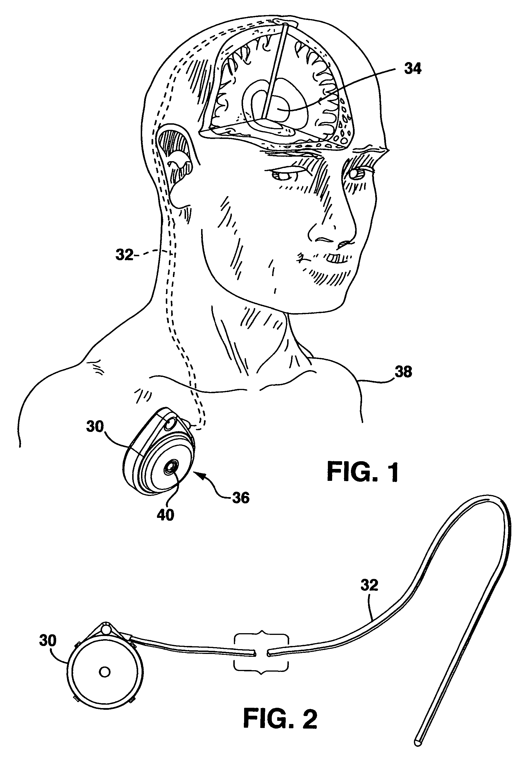 Implantable therapeutic substance delivery device