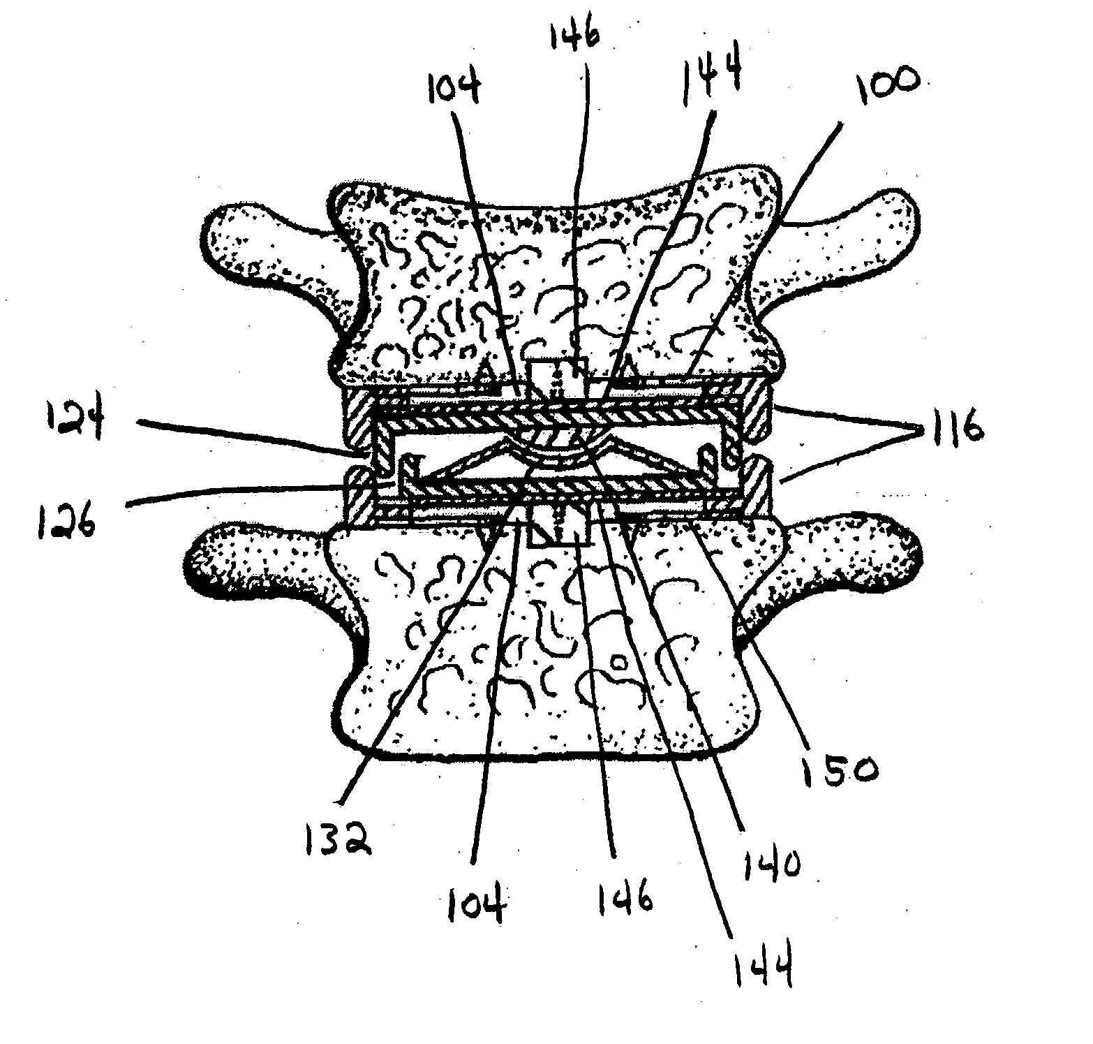 Spinal disc prosthesis system