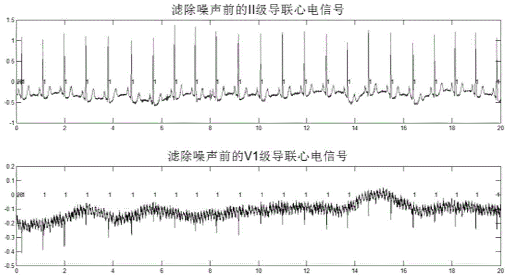 Multistage lead electrocardiograph signal QRS waveform identification method