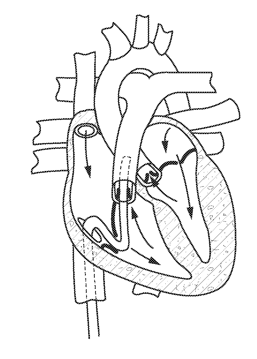 Method of Using Catheter with Rotating Portion