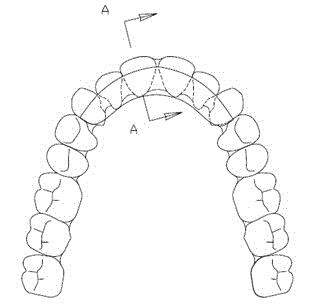Novel oral cavity orthodontic appliance