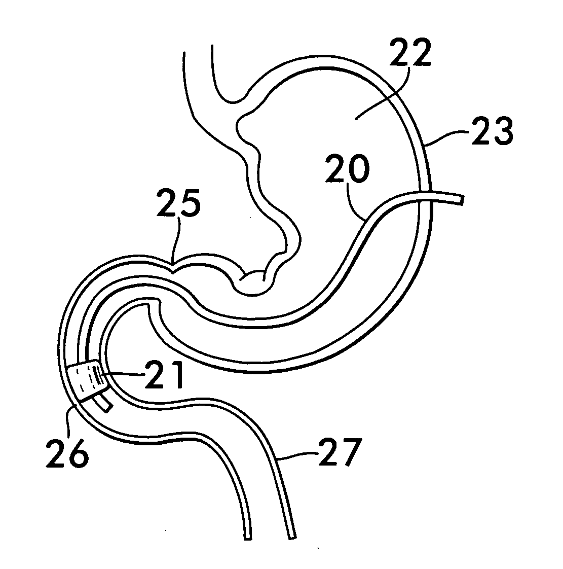 Gastrojejunal feeding tube